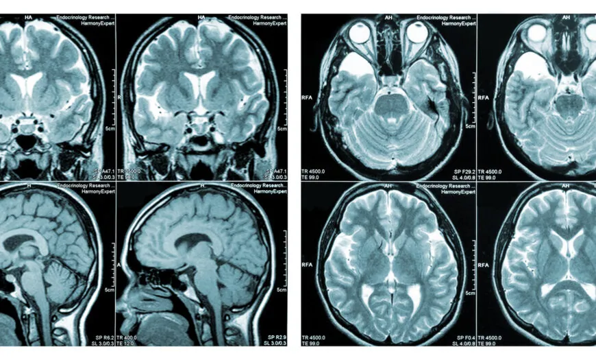 Brain Injuries After COVID Vaccination