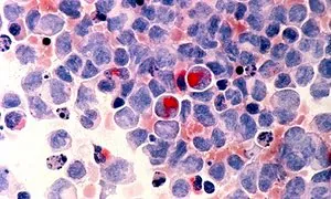 Cancer Drugs Fund Found to be Expensive and Ineffective, Massive Health Error