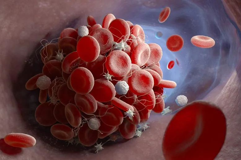 First Reported Cases of Blood Clots Causing Stroke in Young Adults Following COVID-19 Vaccination