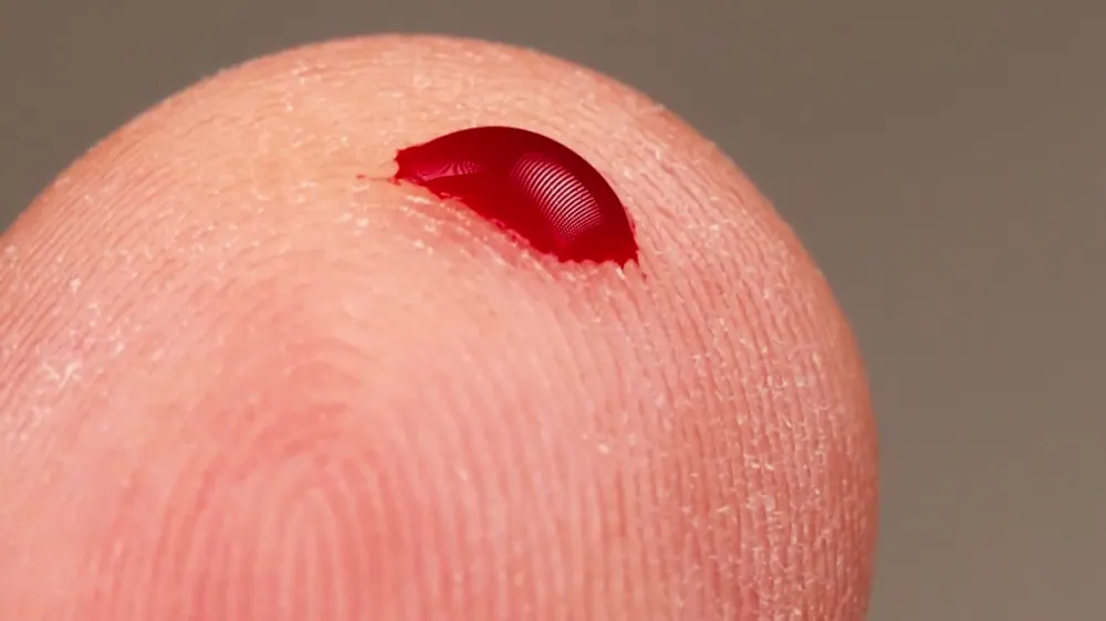 Does Meat Consumption Aid In the Development of Type 1 Diabetes?