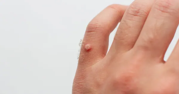Natural Remedies to Get Rid of Warts